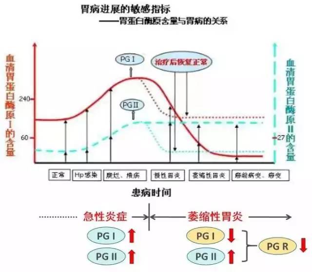 胃功能三项检查准确诊断早期胃癌的利器