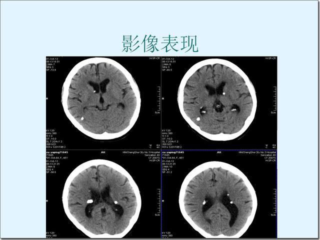 结节性硬化症