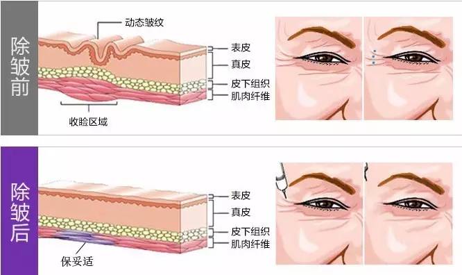 去皱针什么原理_打去皱针初期吓人图片(2)