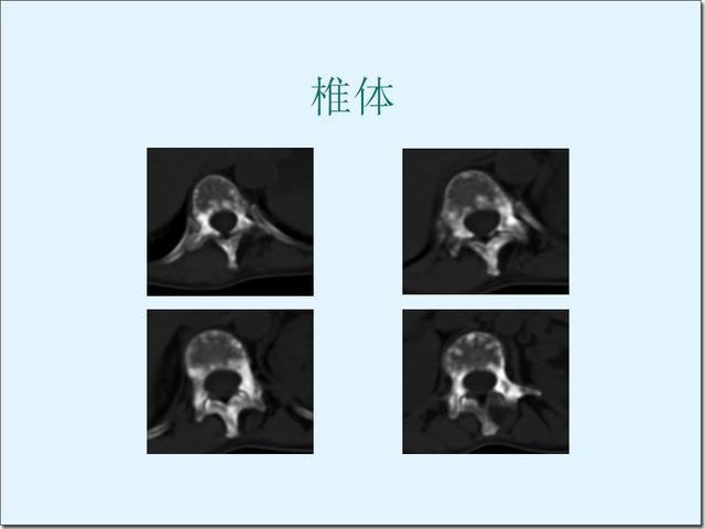 结节性硬化症