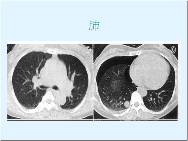 结节性硬化症