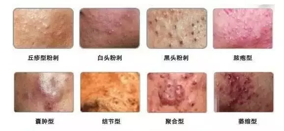 痤疮,俗称青春痘,暗疮,中医古代称之为面疮,酒刺,是一种发生于毛囊