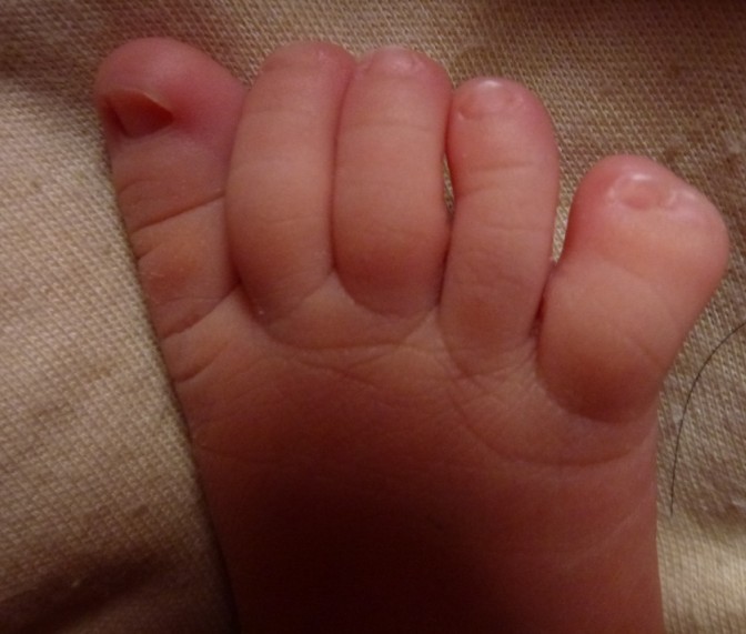 宝宝生出来脚上长了6个脚趾头婆婆竟说双喜临门