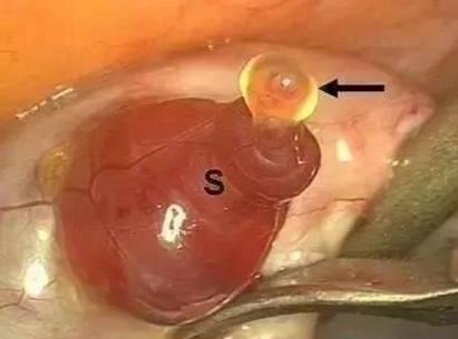 4,卵子慢慢被从卵泡中挤出后,就会进入输卵管,并渐渐移动至输卵管壶部