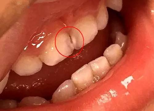 如果置之不理,牙缝间的龋坏面积将迅速扩大,后果不堪设想.