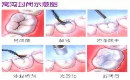 做窝沟封闭疼吗几岁做最好做后不再得虫牙吗