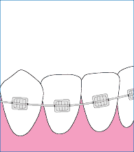 牙齿矫正以后该怎么刷牙呢?