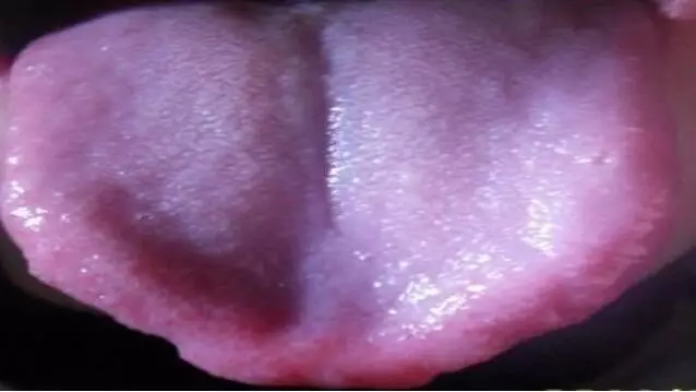 2,舌头发紫