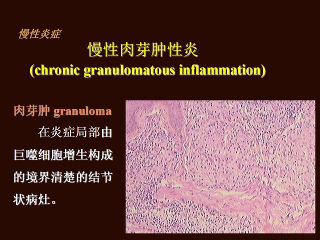 减张引流;1,对症:抗生素消炎 局部换药;治疗:脓肿:慢性肉芽组织样及炎