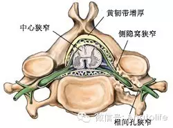 为上关节突和黄韧带的侧份61侧隐窝向外下续为椎间孔61前壁:是