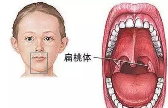 孩子扁桃体肥大,治也治不好,总是发炎→肿大→发烧,是一件很让家长