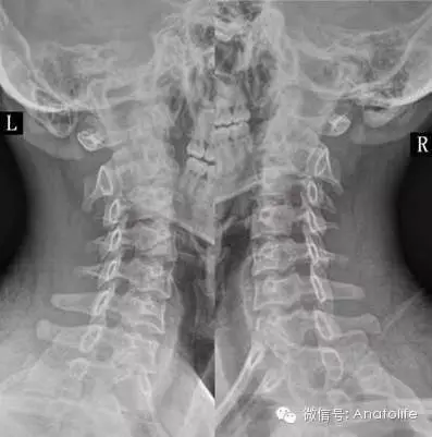 显示脊柱较完整的影像 双斜位:检查椎间孔,上下关节突关节和腰椎峡部