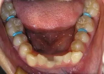 牙齿矫正流程