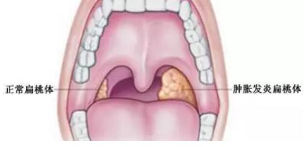 孩子扁桃体反复发炎肿大千万别随便摘除