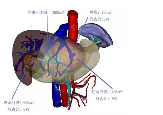 肝尾状叶巨大肿物复杂肝癌顺利手术切除