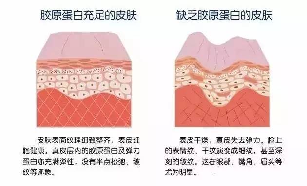 胶原蛋白流失带来 皮下支撑结构的崩解是面部松弛的另一重要原因.