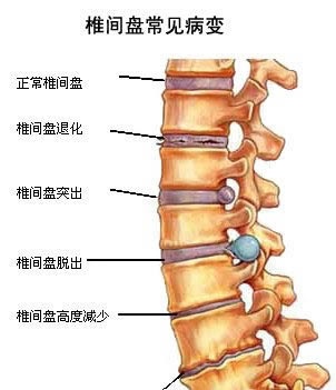 腰突最怕三伏天犯病,解决7年腰痛难题,学会方法