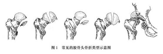 的位置越靠近股骨头,越是能够容易引起股骨头缺血性的坏死,就像是股骨