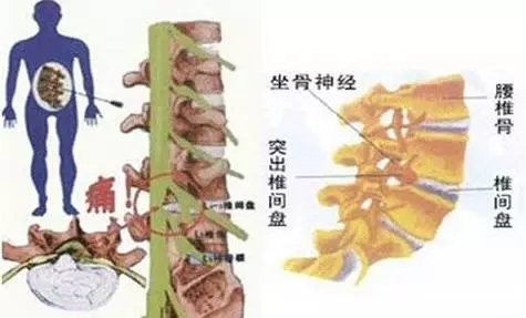 你患腰椎盘突出多少年被病痛折磨的你还好么