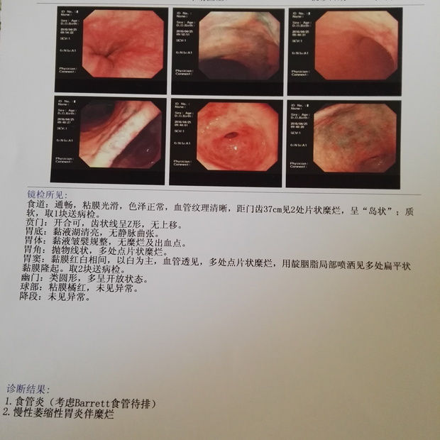 老师根据我的病情分析,原来是我胃酸分泌较多,胃黏膜多处破损甚至出血