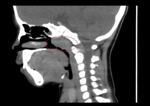 ct检查发现,小芸肥大的腺样体几乎堵住了后鼻孔,同时伴有扁桃体肥大.
