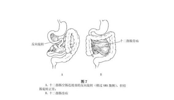 左下腹隐痛,有伴随腰痛.而且屁多 左下腹隐痛腰痛内科