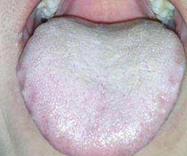 中医将齿痕舌或者舌苔白腻,黄腻,厚,大便粘黏或溏稀不成形,满脸油腻