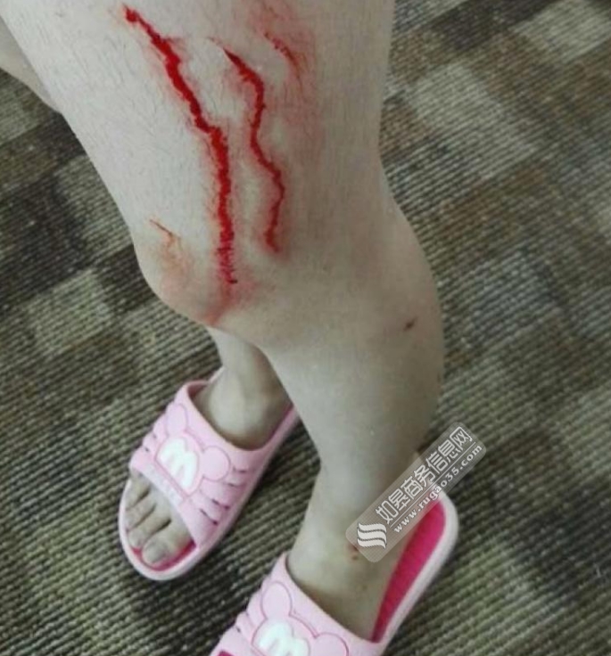 上海一酒店浴室玻璃爆裂 15岁女孩被划伤浑身是血