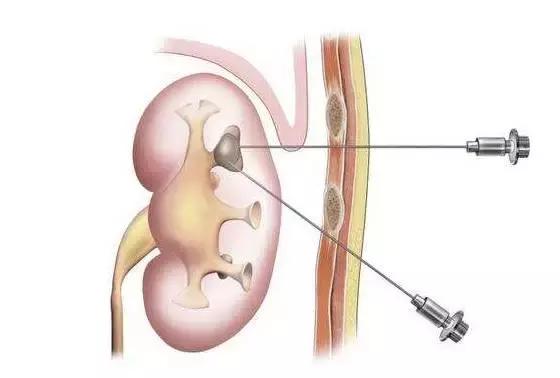尿结石不用开刀,"经皮肾镜"取石还有一大波好处