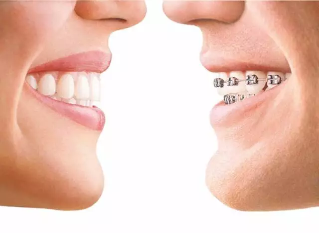 最便宜的牙_三种牙齿矫正方式你喜欢那种