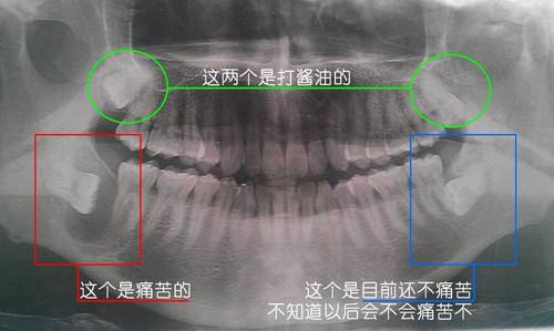 通常智齿萌发的空间不足,而会倒在第二大臼齿上,因而造成第二大臼齿