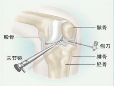 腰间盘突出微创手术是什么原理_腰间盘突出微创手术图(2)