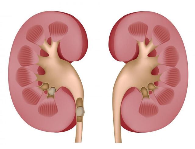 从中医里了解肾结石解决掉结石