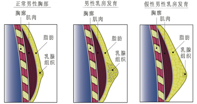 王永春医生访谈 | faq,男性乳房发育症30问