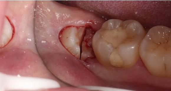 第三步:把挺刃插在所拔牙牙齿的近中面或颊侧面与牙槽骨之间,撬动牙齿