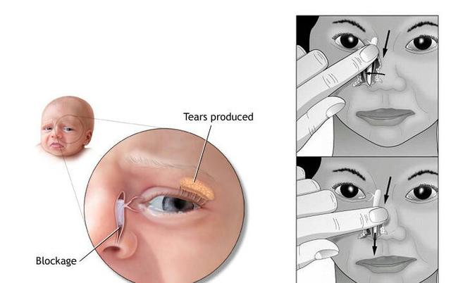 一,为什么会流黄泪 这通常是由于输泪管堵塞引起的.