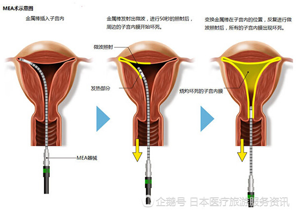 子宫脱垂的症状是什么样的情况呢?