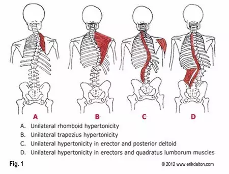 由于特发性脊柱侧弯是慢慢发生变化的,所以它的恢复过程也是很缓慢