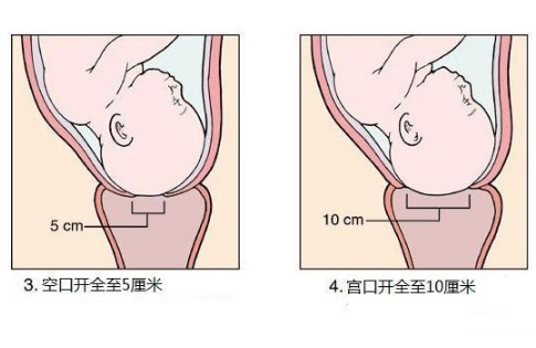 分娩中"开十指"是什么意思?附图