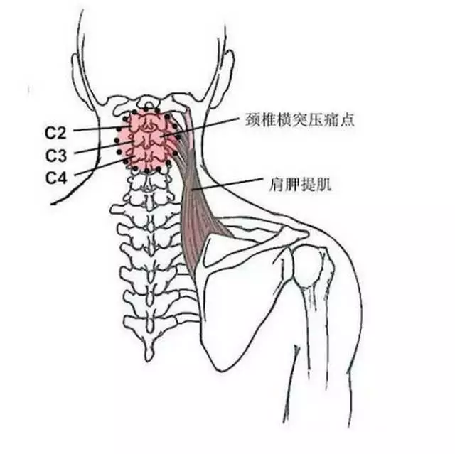 4.颈椎棘突压痛点