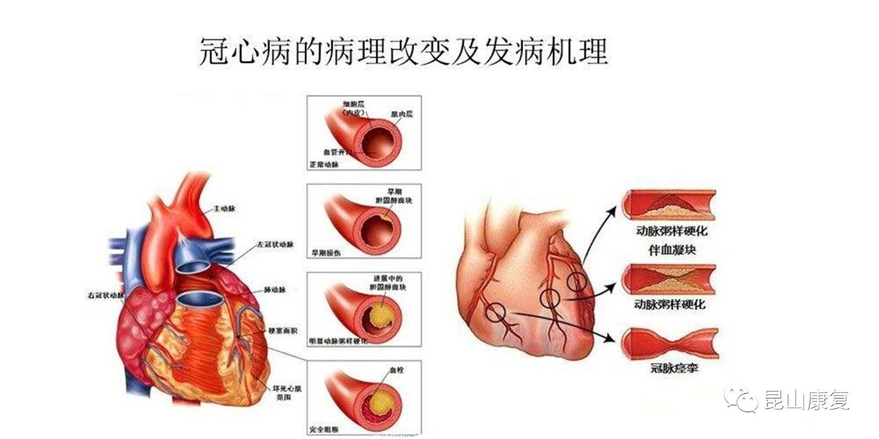 冠心病的康复是综合性心血管病管理的医疗模式,不是单纯的运动治疗