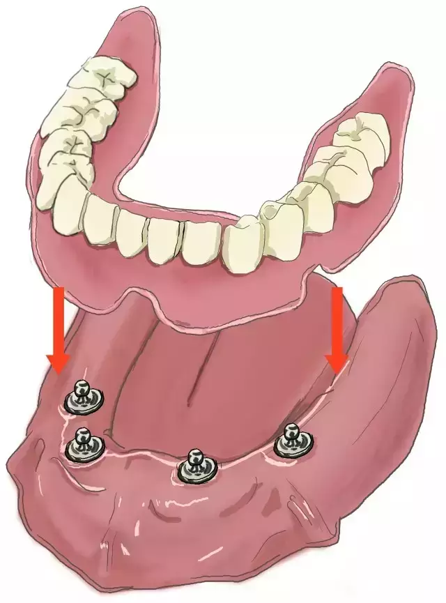 史上最简单明了的种植牙介绍!