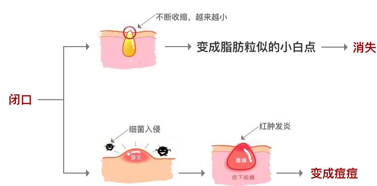 闭口人口_闭口粉刺图片(2)