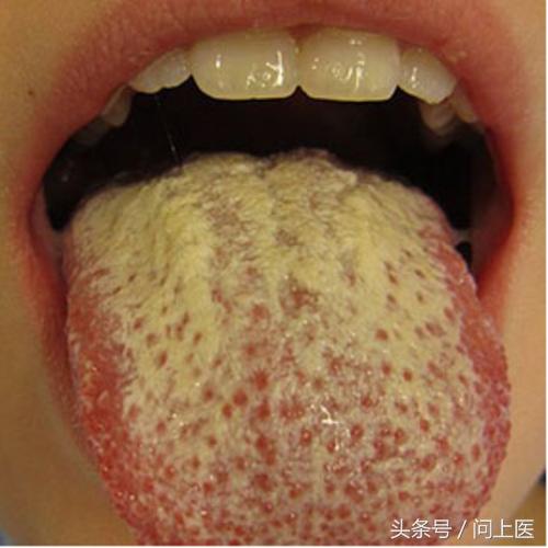 艾滋病病毒在口腔里引发的像菜花一样的小疙瘩,通常被称之为艾滋病