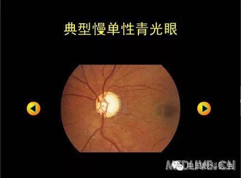 眼底镜 | 下的各种眼病图谱