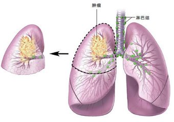 肺癌晚期病人口臭_肺癌晚期病人图片(3)