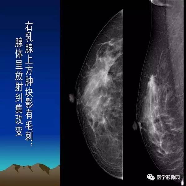 乳腺癌的钼靶诊断丨影像天地