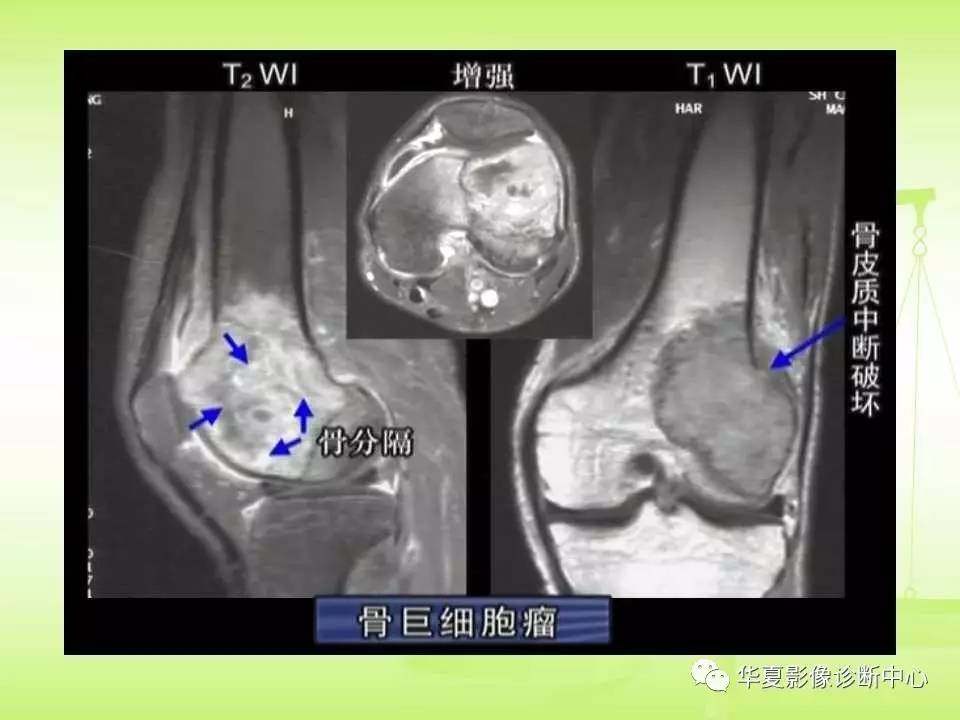 骨关节骨肿瘤及肿瘤样病变的mri诊断