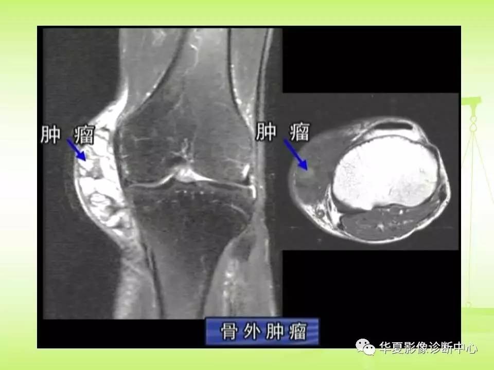 骨关节骨肿瘤及肿瘤样病变的mri诊断