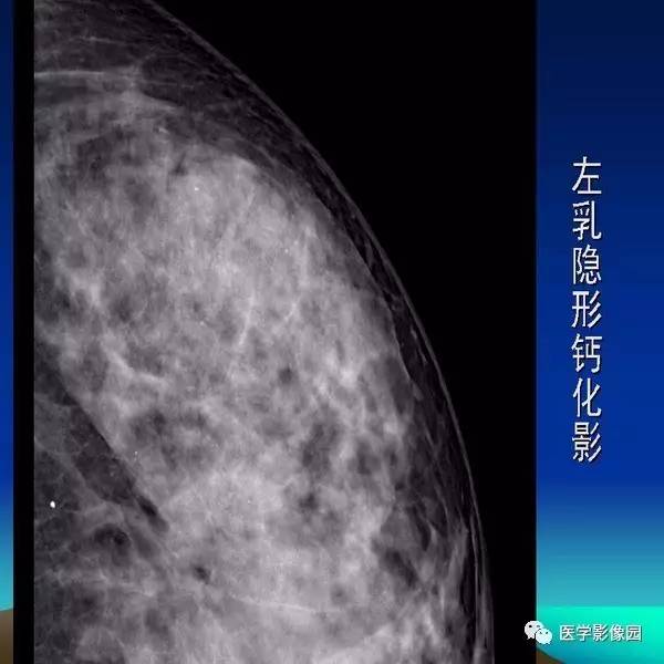 乳腺癌的钼靶诊断丨影像天地